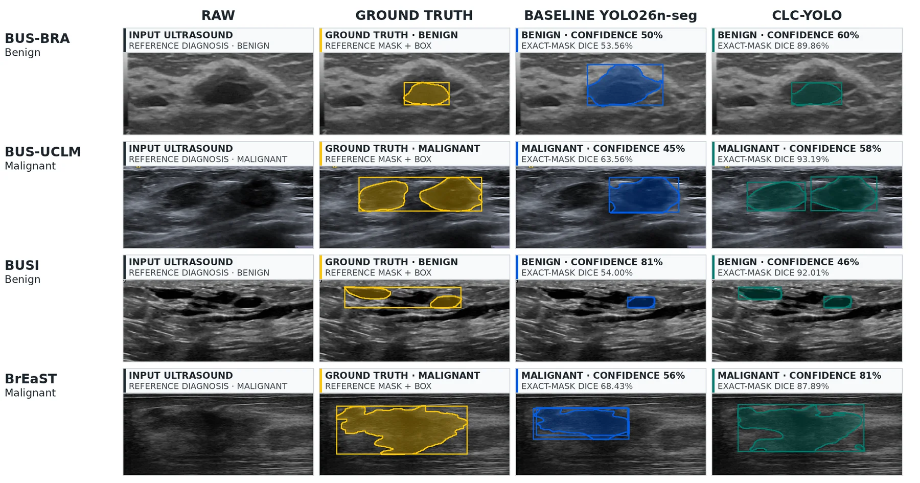 Two benign and two malignant cases, selected for favourable CLC Dice differences: raw image, ground truth, baseline YOLO26n-seg and CLC-YOLO.